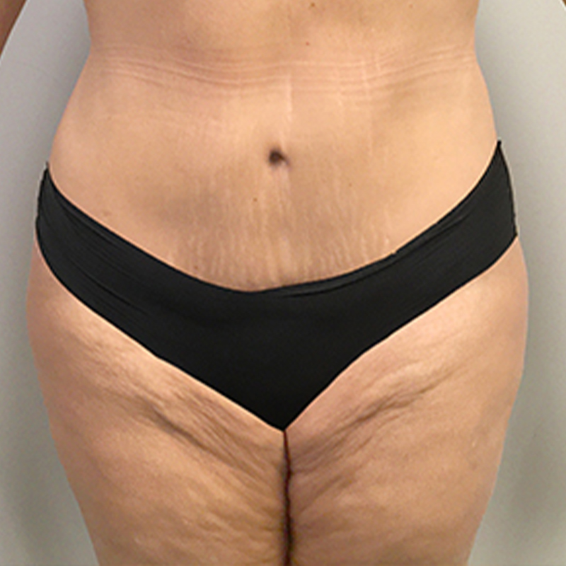Abdominoplasty 15