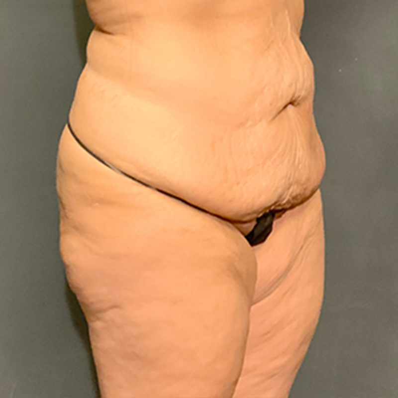 Abdominoplasty 03