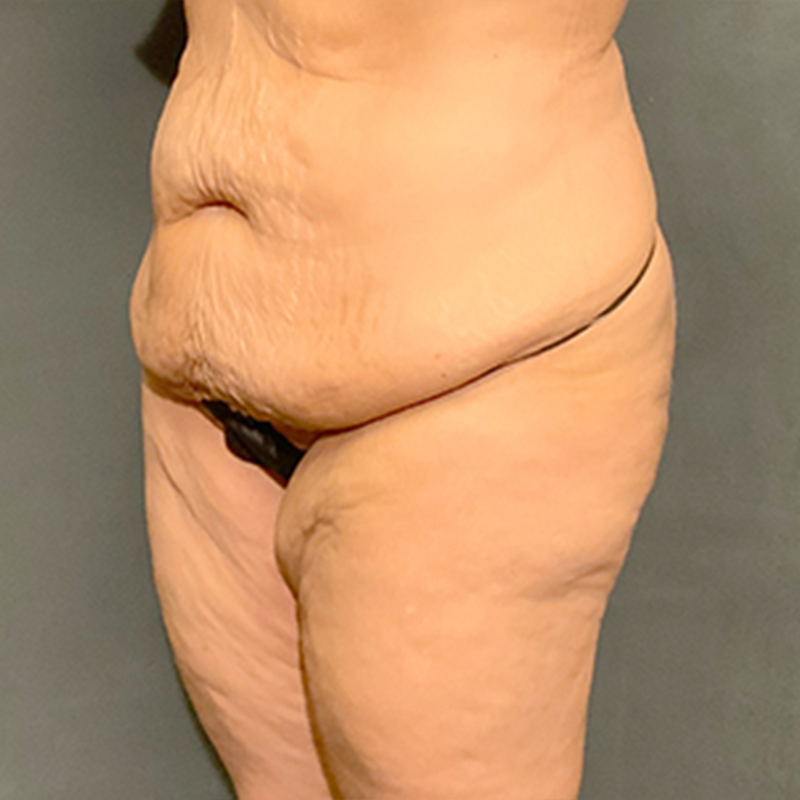 Abdominoplasty 07