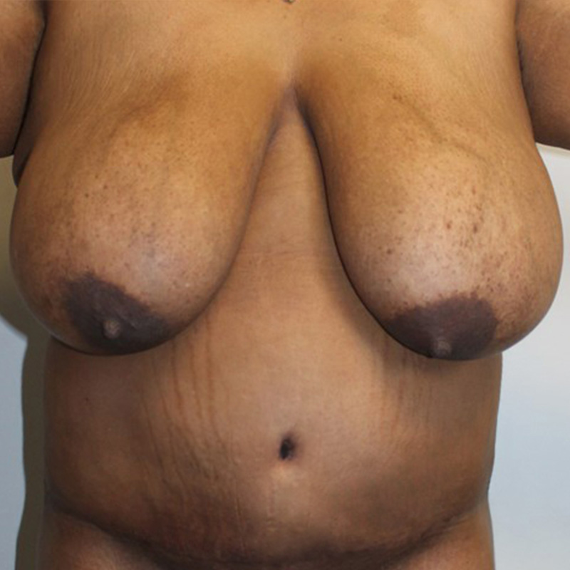 Abdominoplasty 16