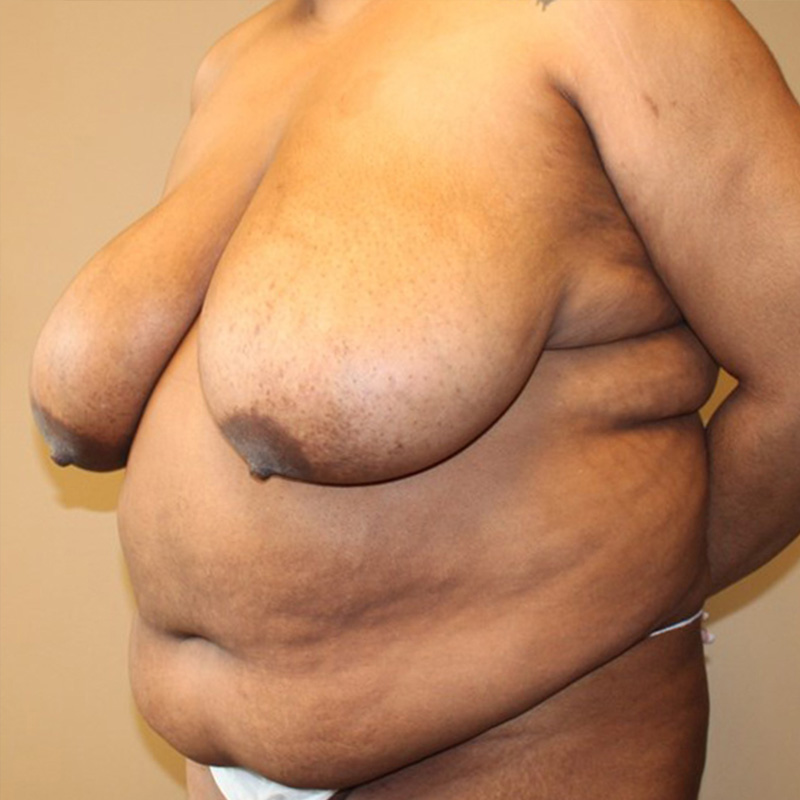 Abdominoplasty 07