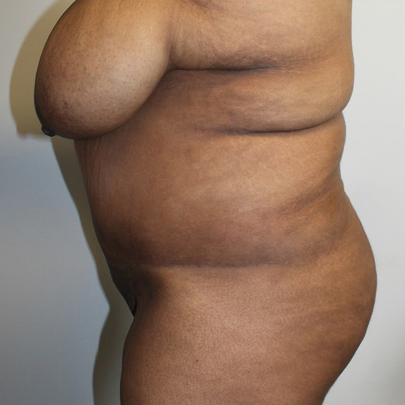 Abdominoplasty 09
