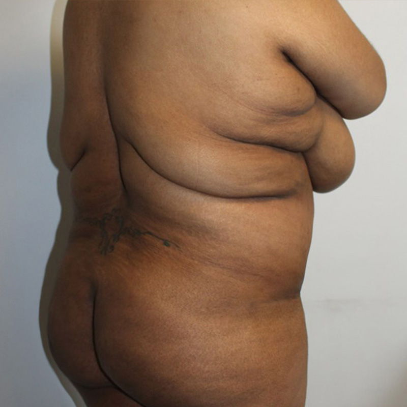 Abdominoplasty 13