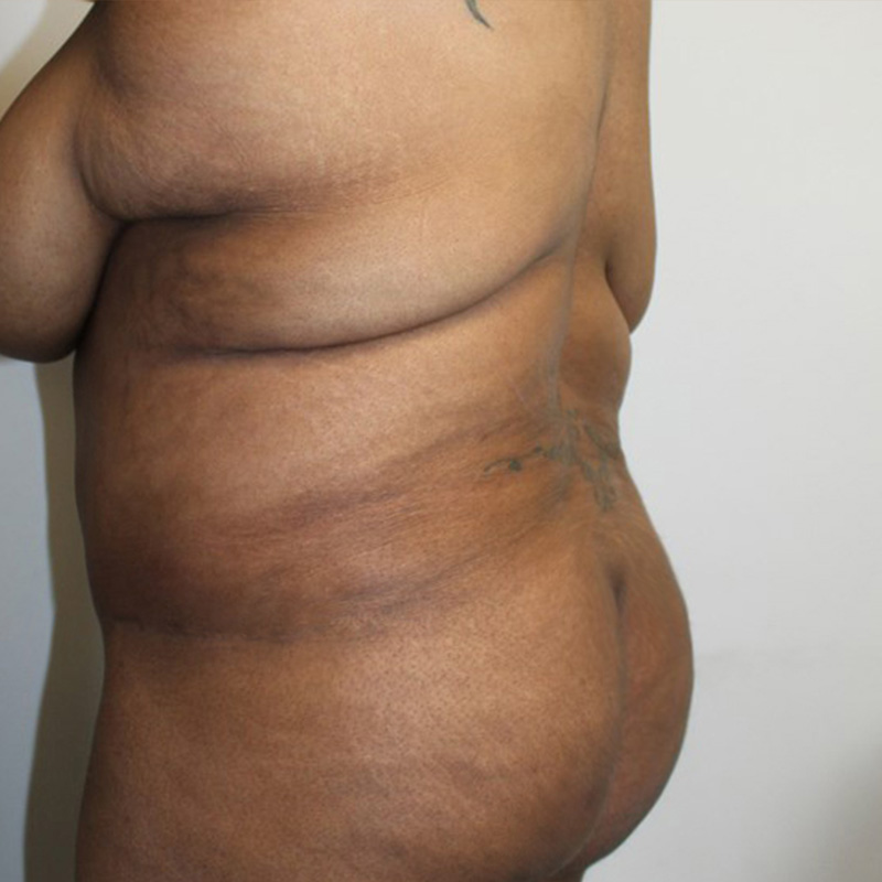Abdominoplasty 15