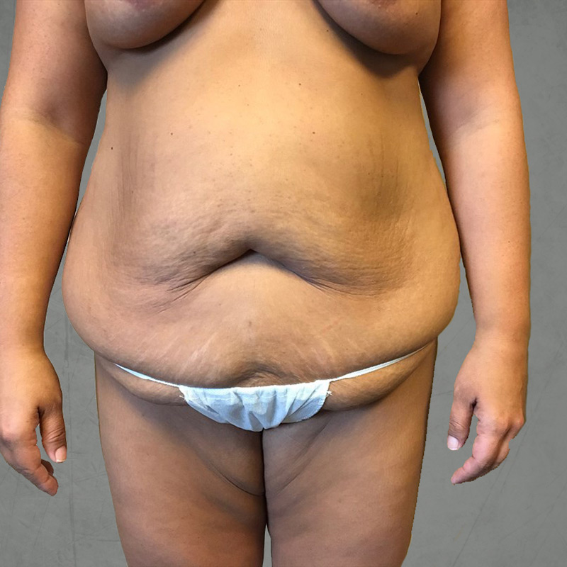 Abdominoplasty 01