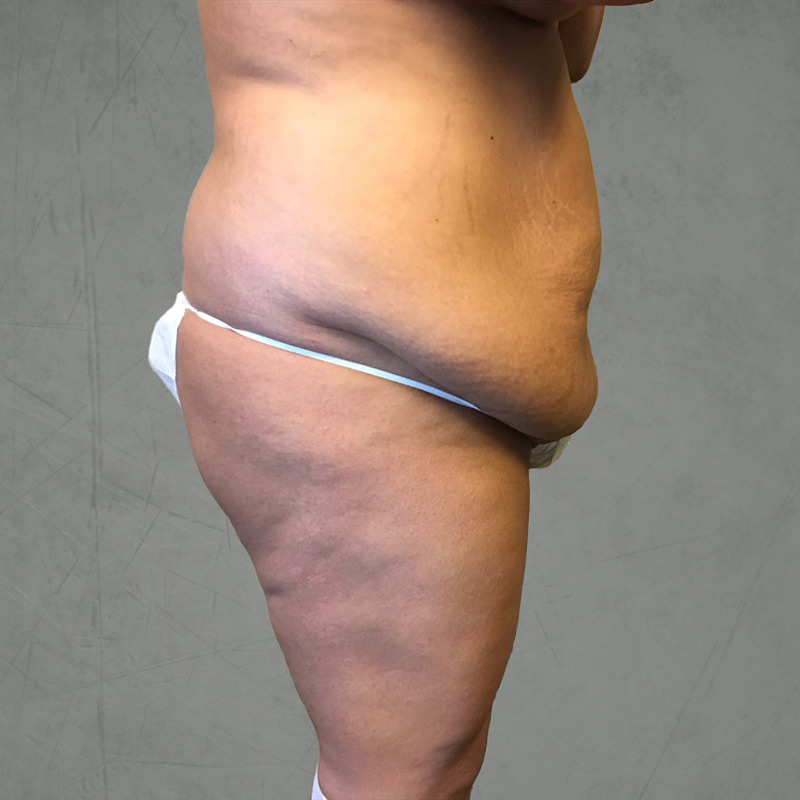 Abdominoplasty 05