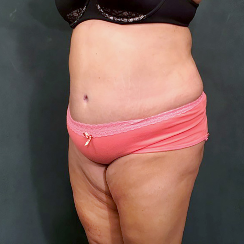 Abdominoplasty 09
