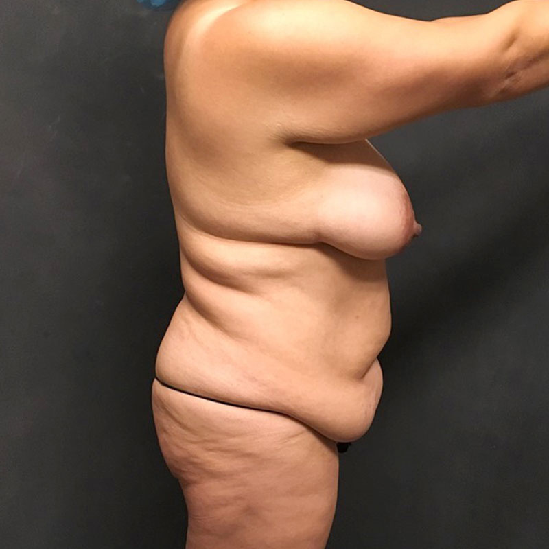 Abdominoplasty 01