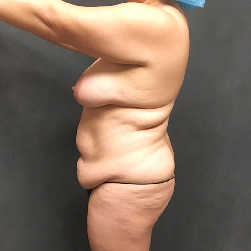 Abdominoplasty 07