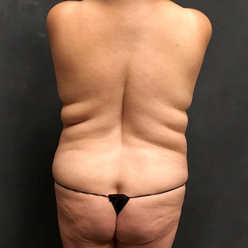 Abdominoplasty 09