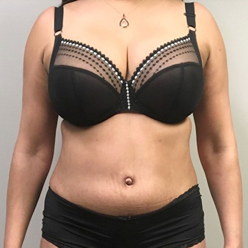 Abdominoplasty 21