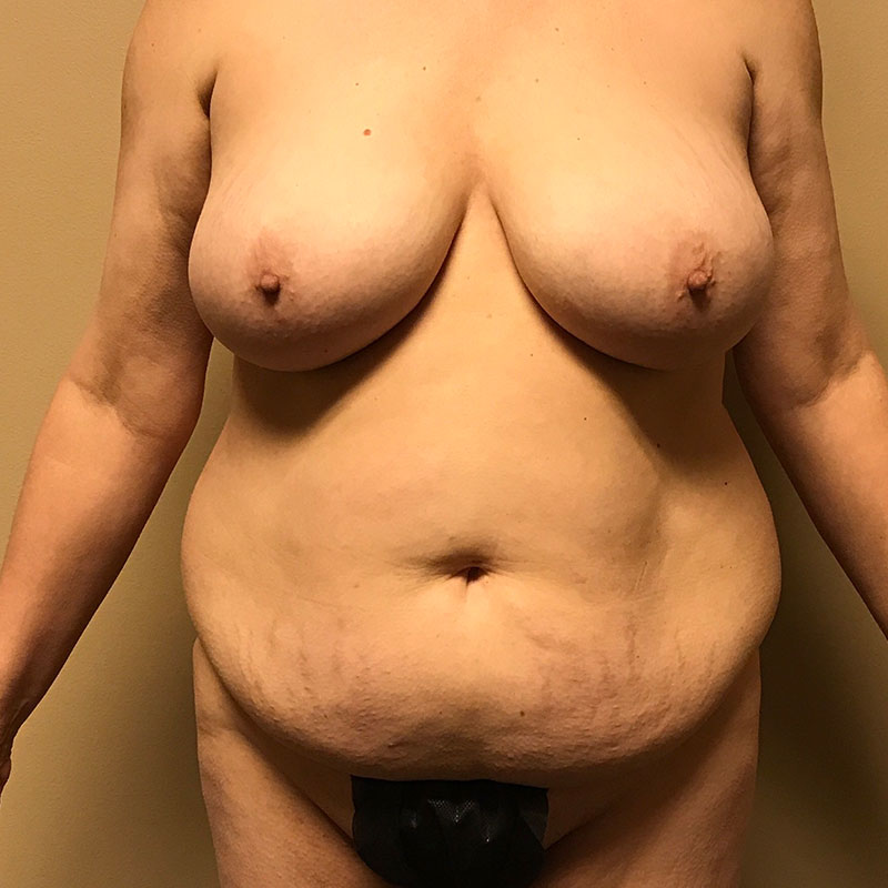 Abdominoplasty 01