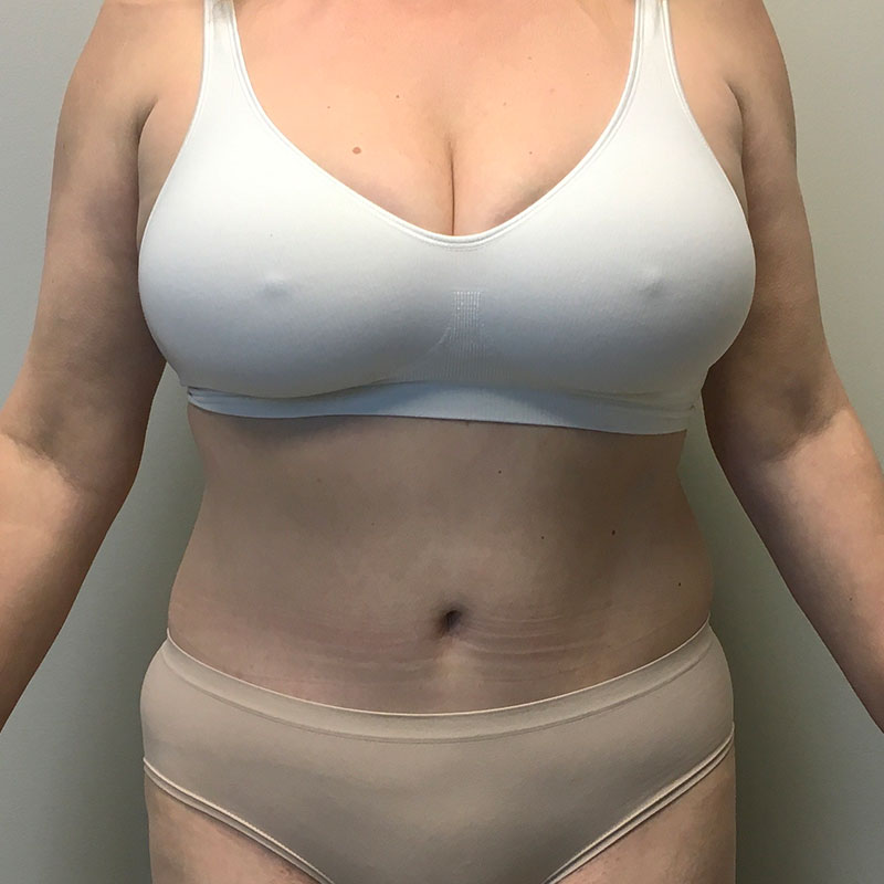 Abdominoplasty 23