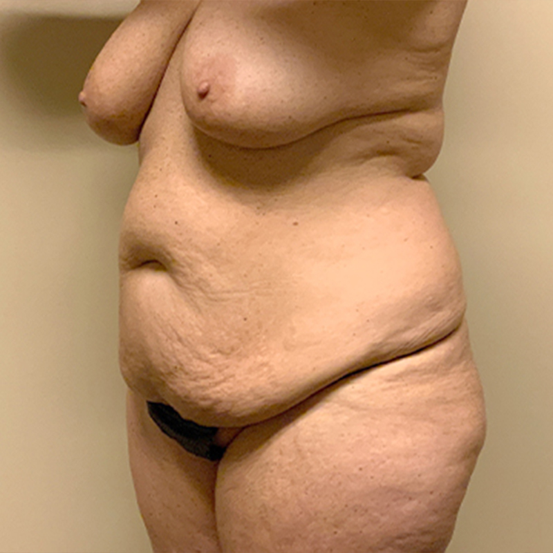 Abdominoplasty 03