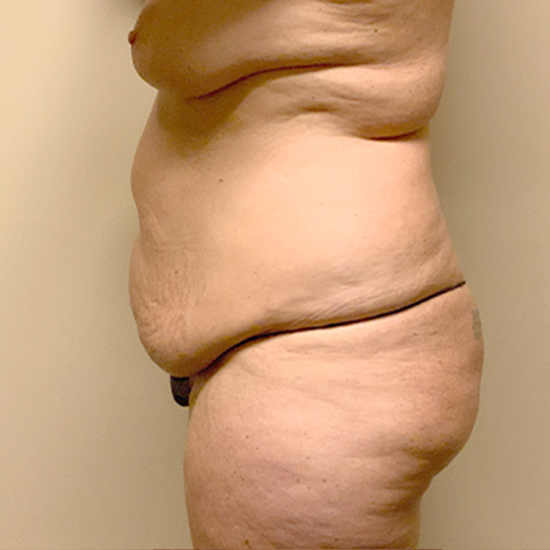 Abdominoplasty 05