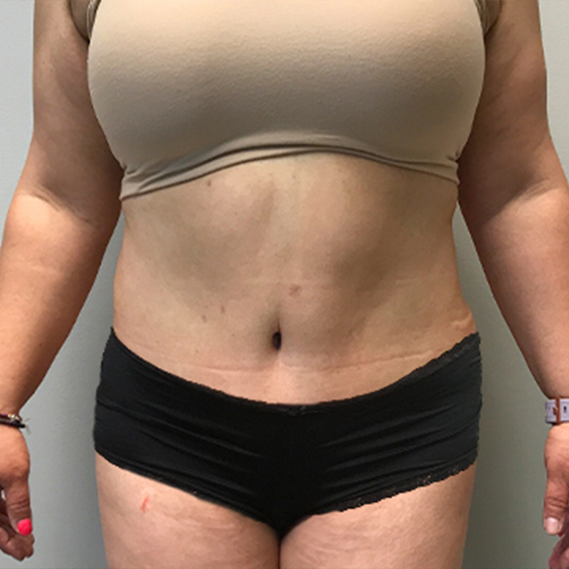 Abdominoplasty 29