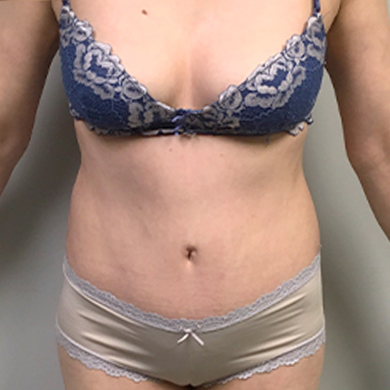 Abdominoplasty 30
