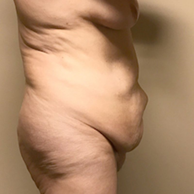 Abdominoplasty 05