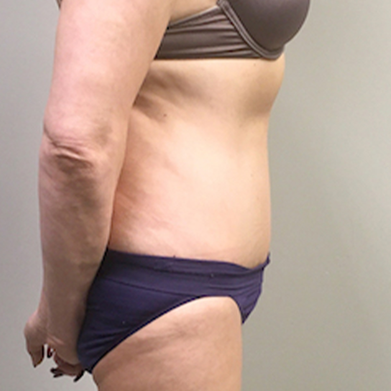 Abdominoplasty 05