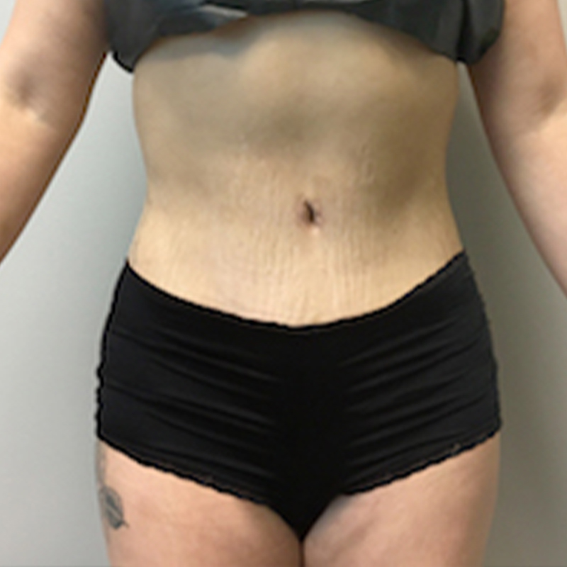 Abdominoplasty 34
