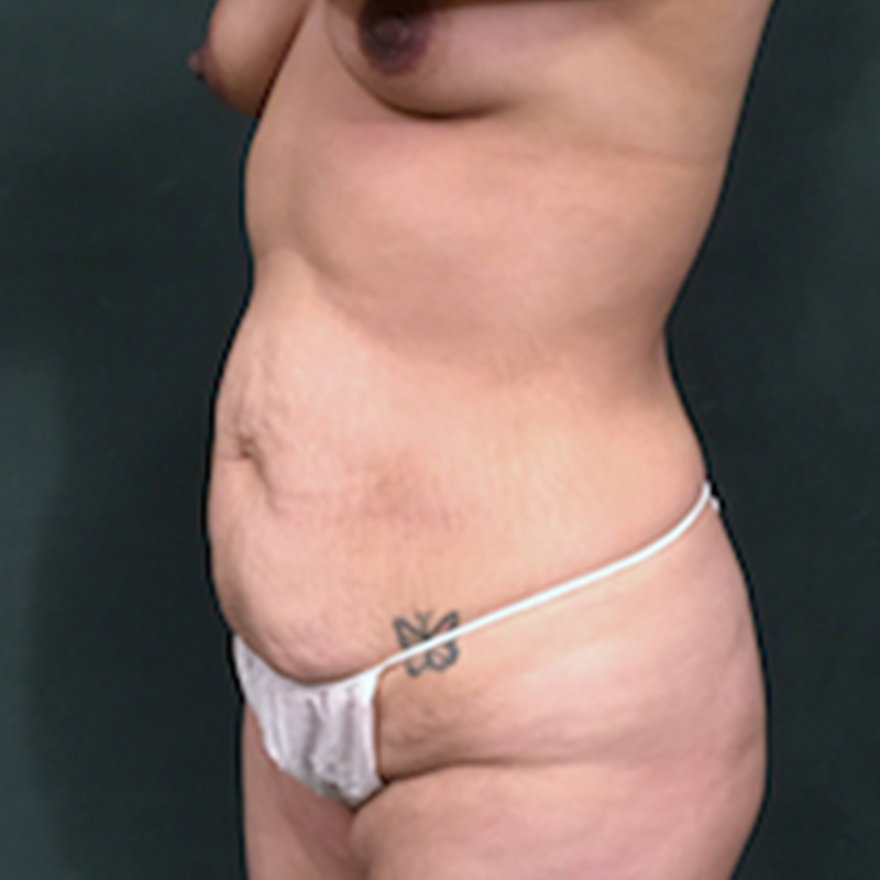 Abdominoplasty 03