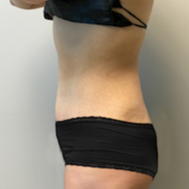 Abdominoplasty 05