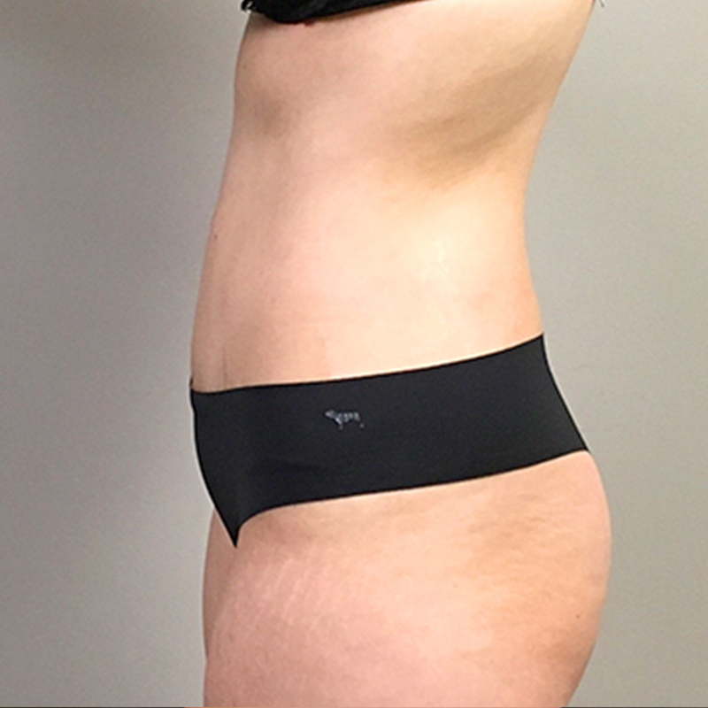 Abdominoplasty 05