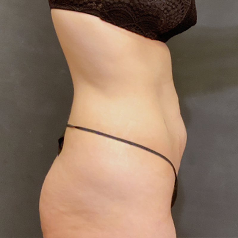 Abdominoplasty 07