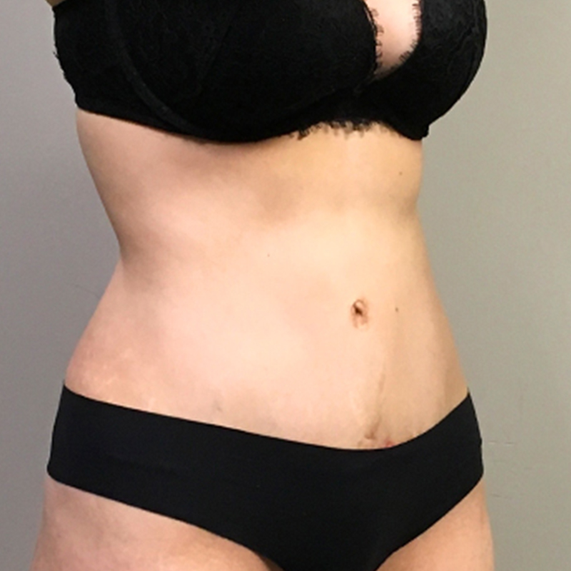 Abdominoplasty 09