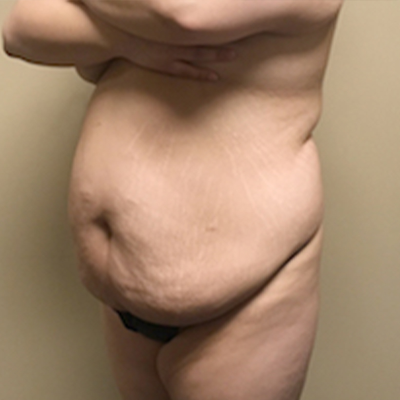 Abdominoplasty 03