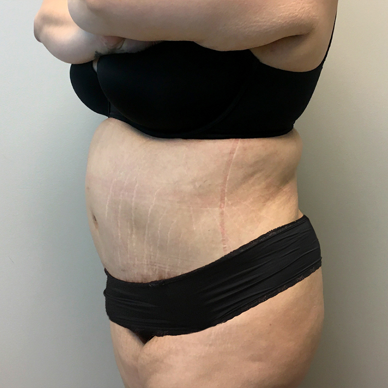 Abdominoplasty 03