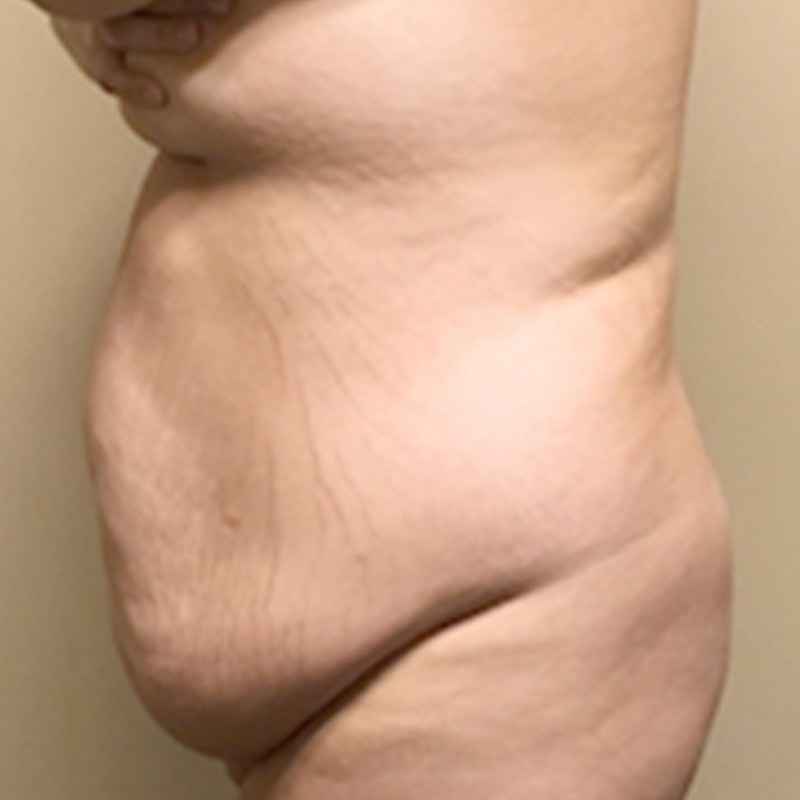 Abdominoplasty 05