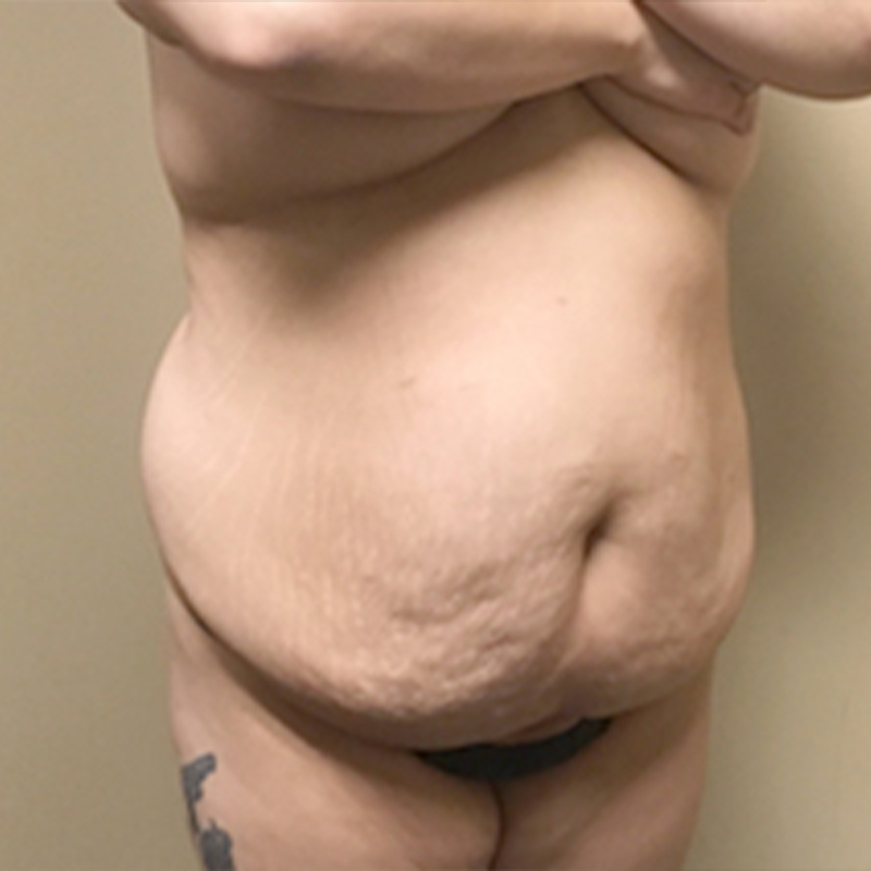 Abdominoplasty 07