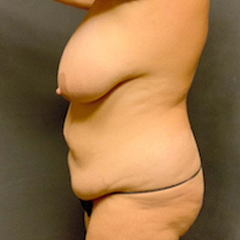 Abdominoplasty 03