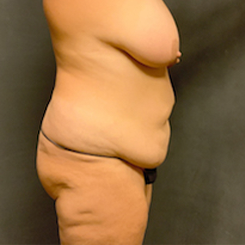 Abdominoplasty 05