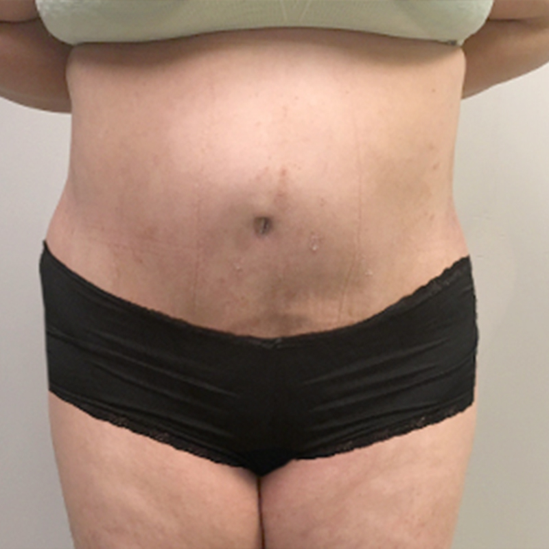 Abdominoplasty 38