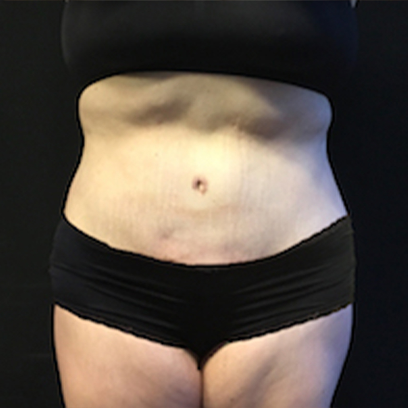 Abdominoplasty 39