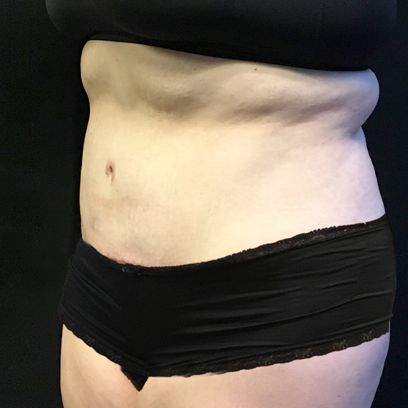 Abdominoplasty 03