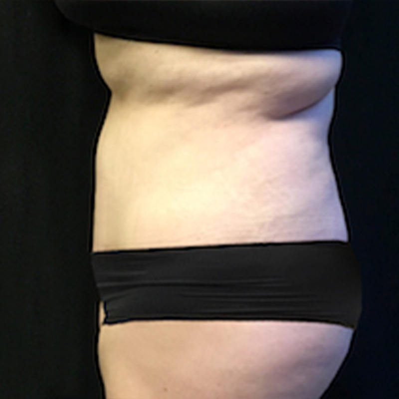 Abdominoplasty 05