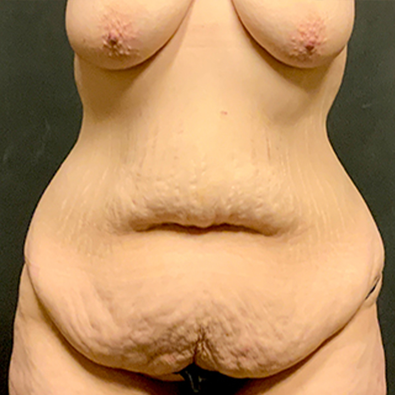 Abdominoplasty 01