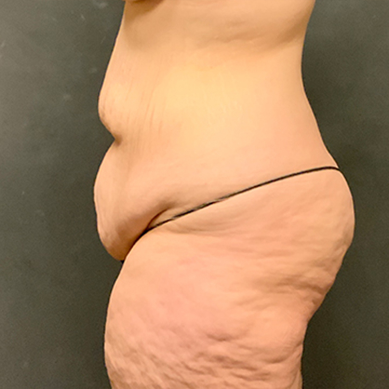 Abdominoplasty 05