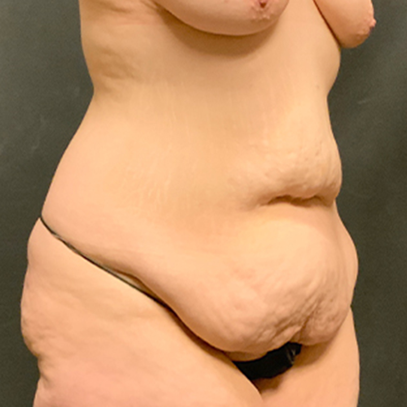 Abdominoplasty 07