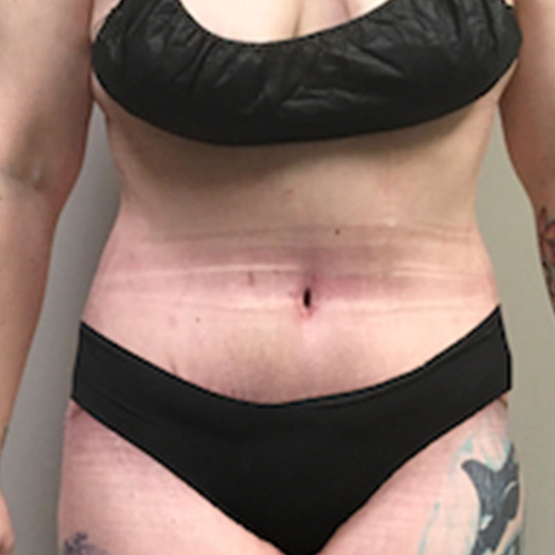 Abdominoplasty 42