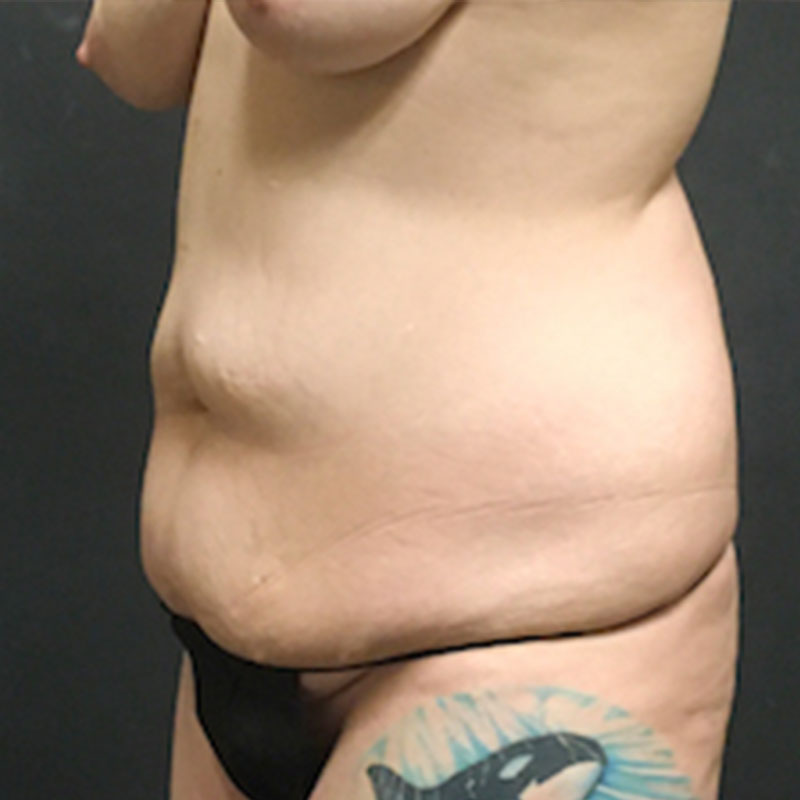 Abdominoplasty 03