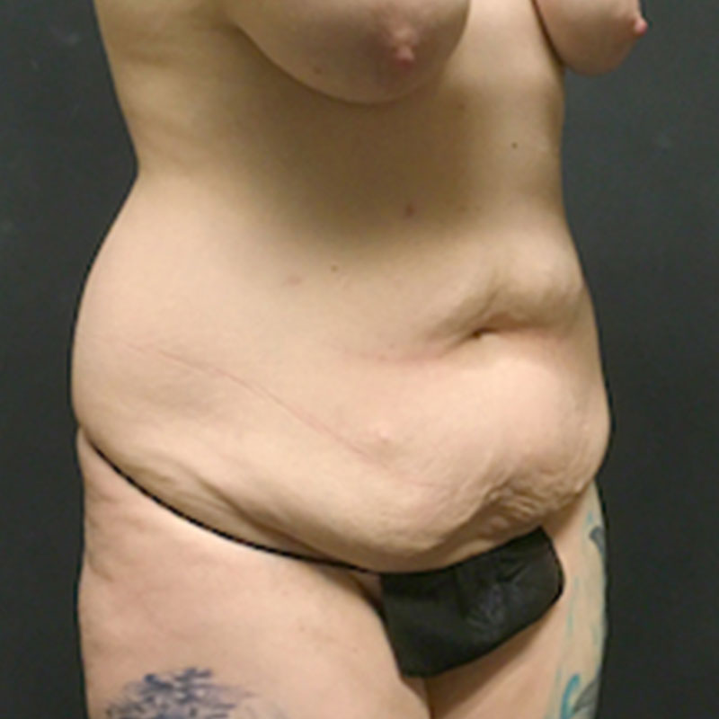 Abdominoplasty 05