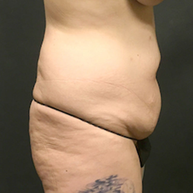 Abdominoplasty 07