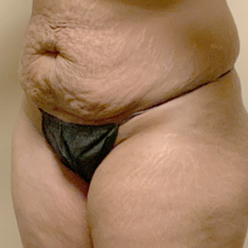 Abdominoplasty 03
