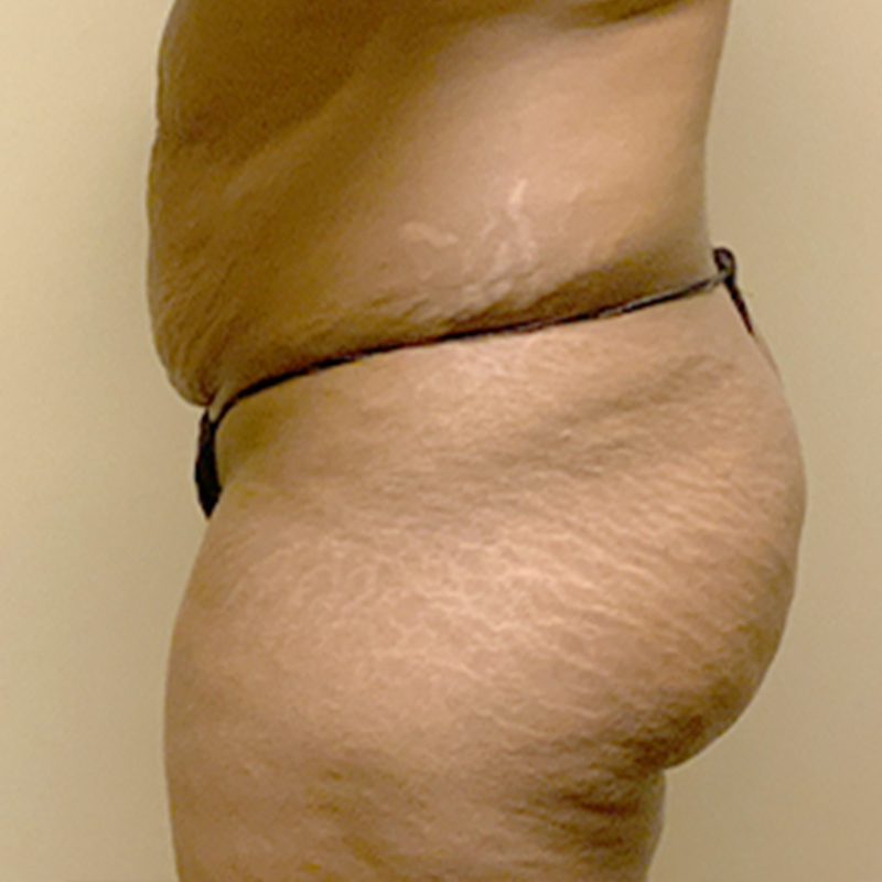 Abdominoplasty 05