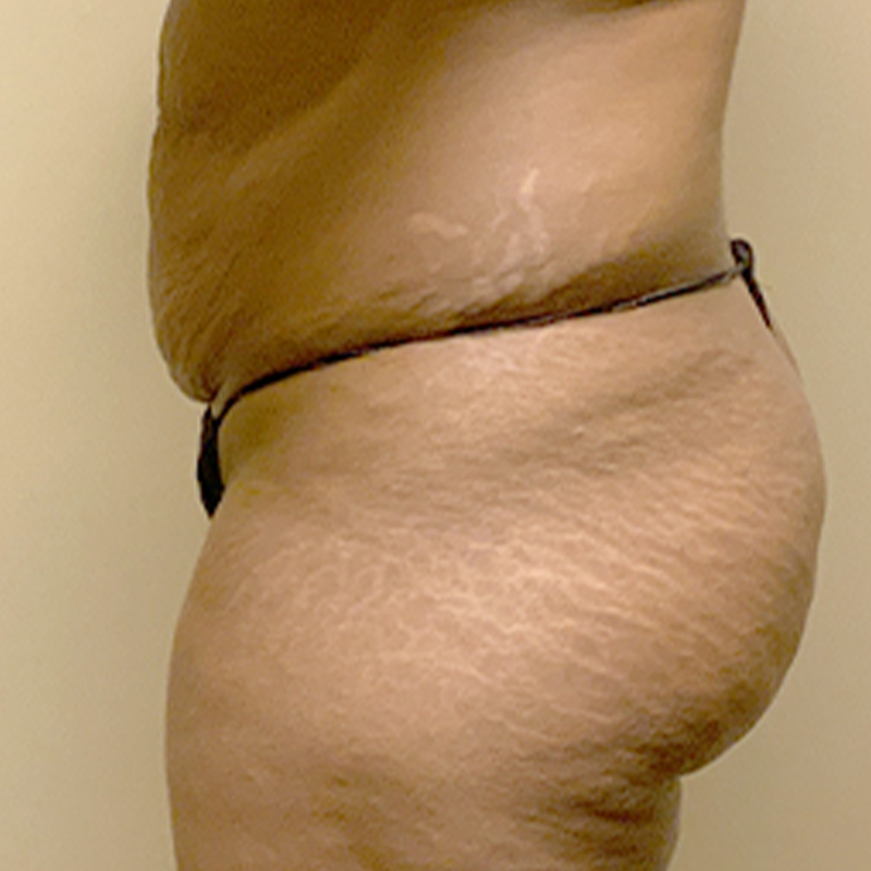 Abdominoplasty 09