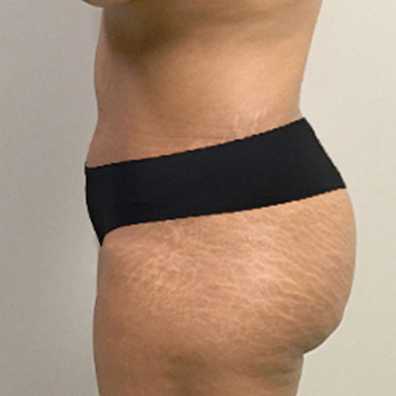 Abdominoplasty 09